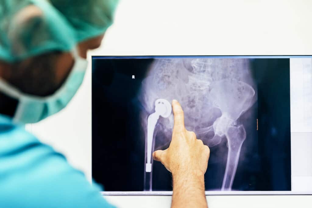 What Do I Do if I Discover I Have a Faulty Hip Replacement? 2 medicine doctor looking x ray image 2021 08 27 23 18 43 utc